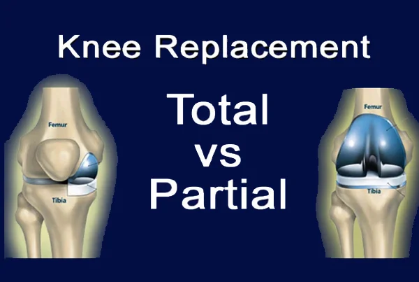 Total and Partial Knee Replacement Surgery