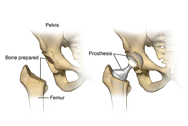 Total and Partial Hip Replacement Surgery