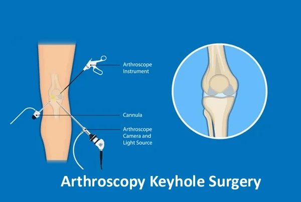 Arthroscopy Key Hole Surgery