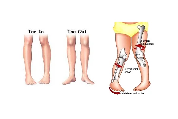 Knock Knee