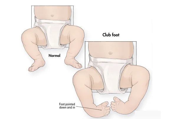 Pediatric Orthopaedics